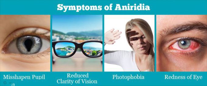 These are the symptoms of Aniridia