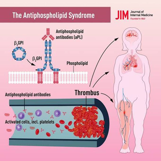 Antiphospholipid syndrome