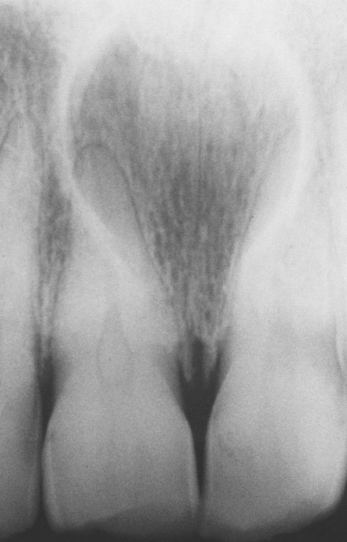 Nasopalatine duct cyst