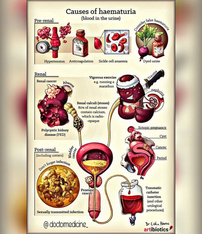 Hematuria