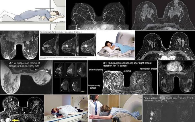 Breast MRI