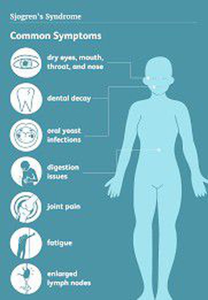 Sjogren syndrome