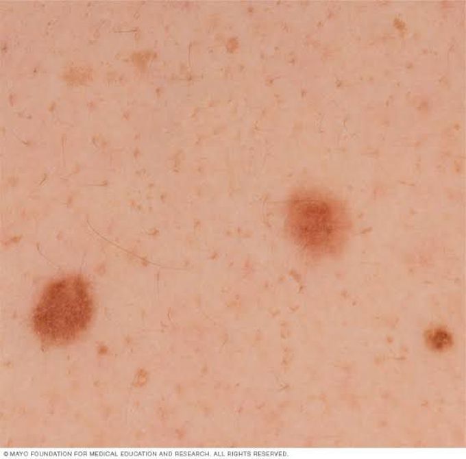 Melanoma