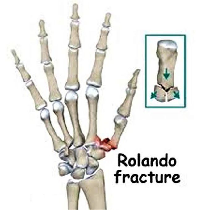 Rolando fracture