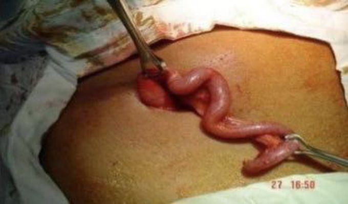 Removed appendix