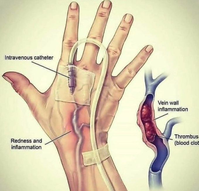 Thrombophlebitis