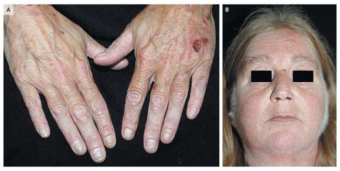 Porphyria Cutanea Tarda and Hypertrichosis