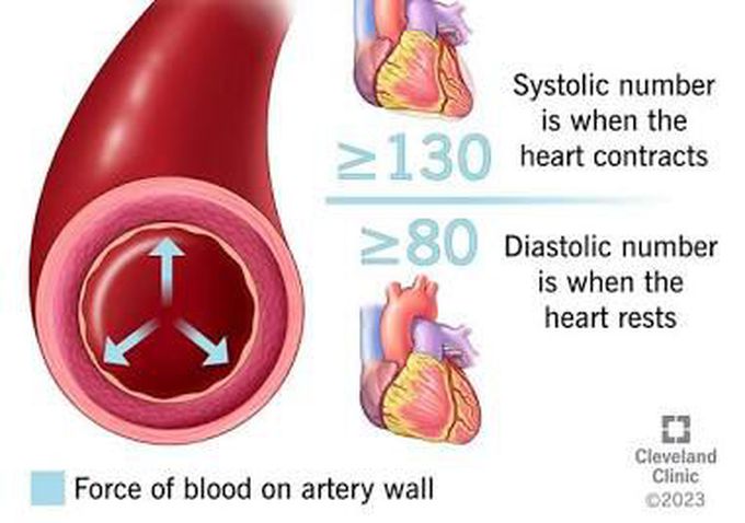 Hypertension