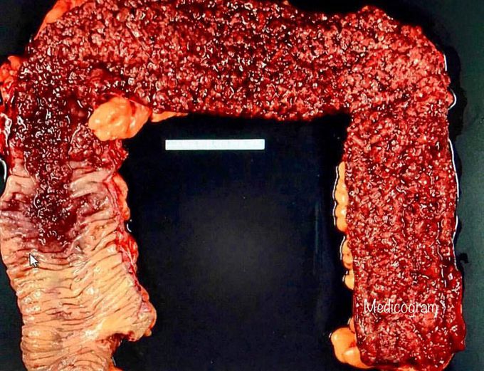 Extensive Ulcerative colitis