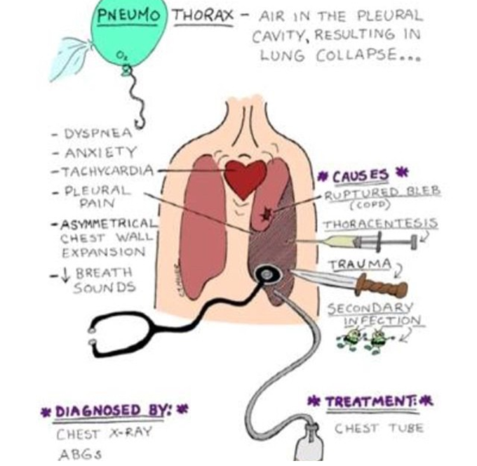 Pneumothorax