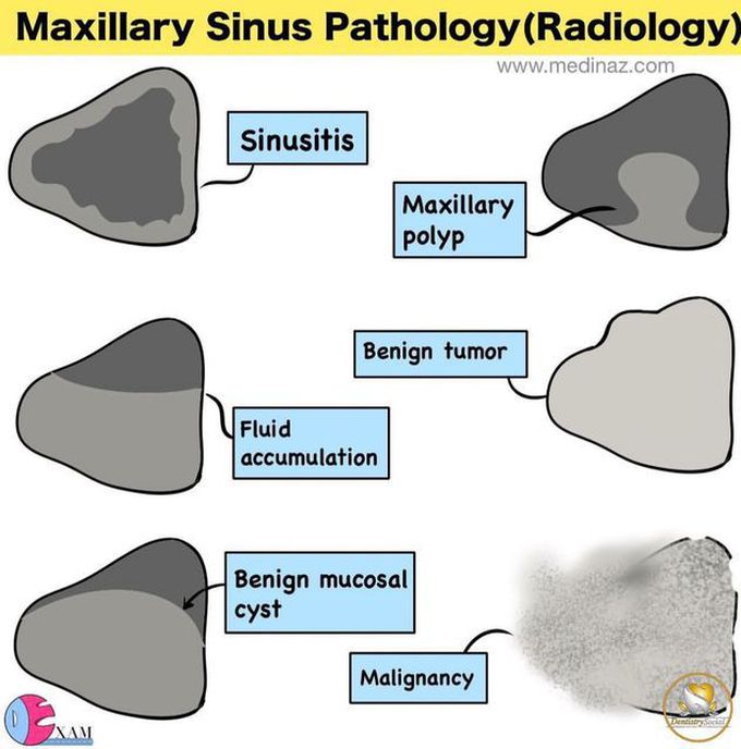 Maxillary Sinus Pathology