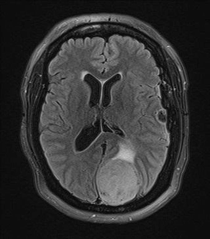 Meningiomatosis