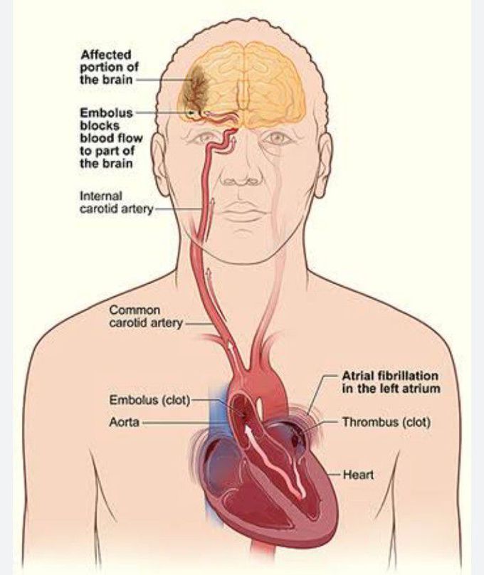 Embolic stroke