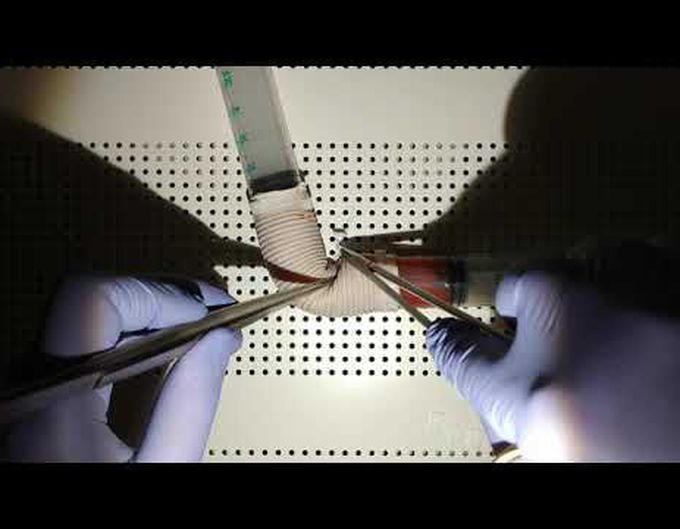 How to Deal With Graft Kinking in Ascending Aortic Surgery