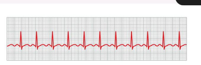 Sinus tachycardia