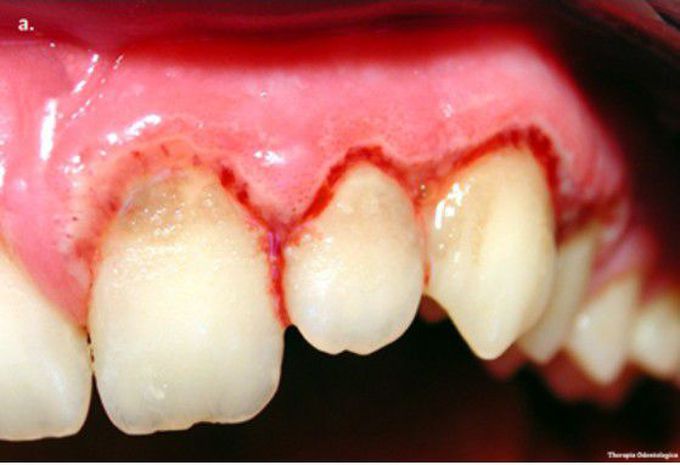 Acute necrotizing ulcerative gingivitis