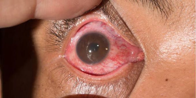 Uveitis symptoms