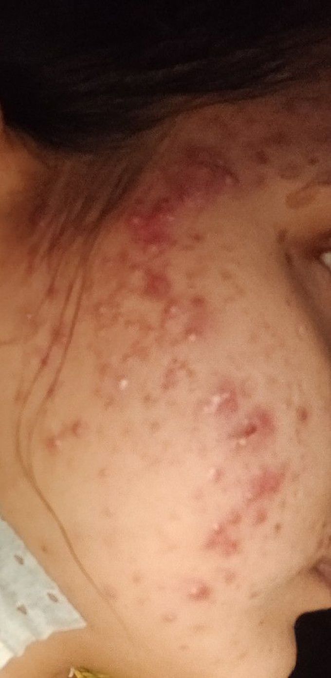 Acne vulgaris