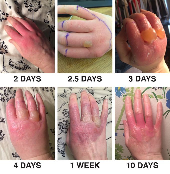 Photodermatitis