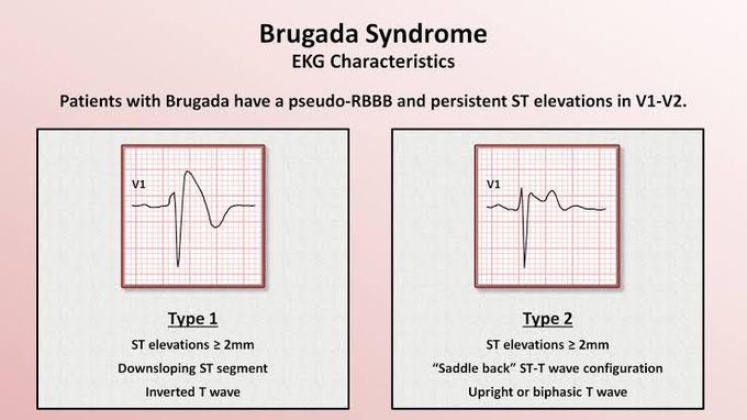 Brugada Syndrome