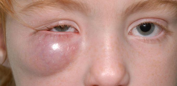 Orbital Cellulitis