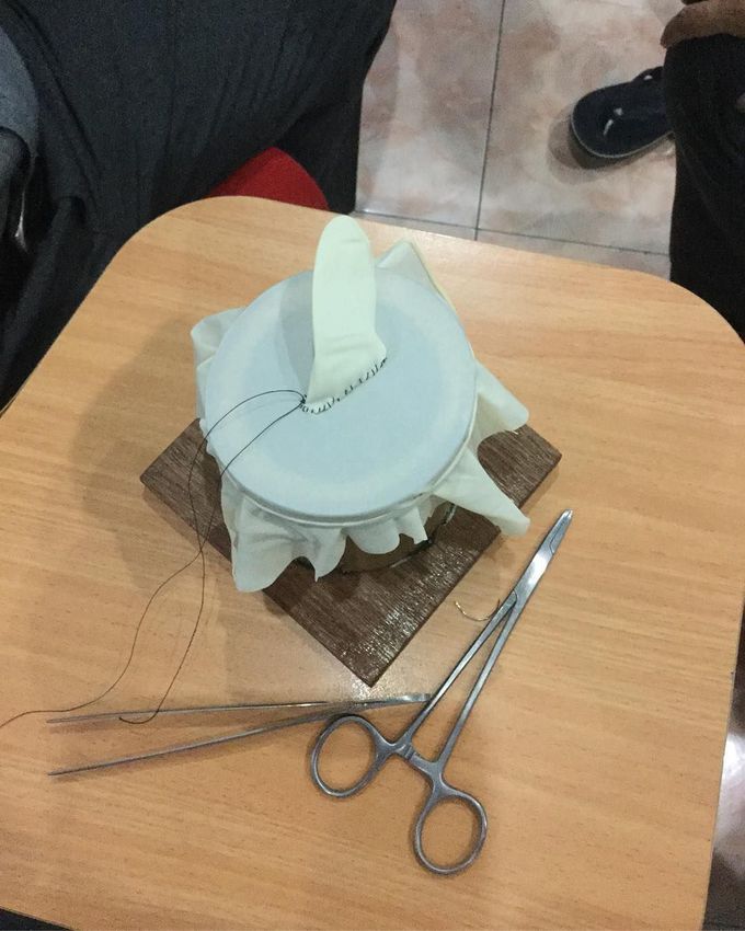 AV shunt anastomotic DIY 
