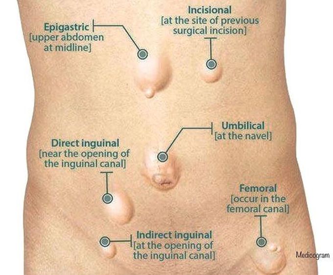 Herniation