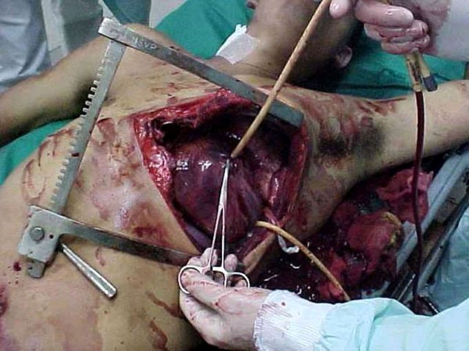 Open heart catheterization
