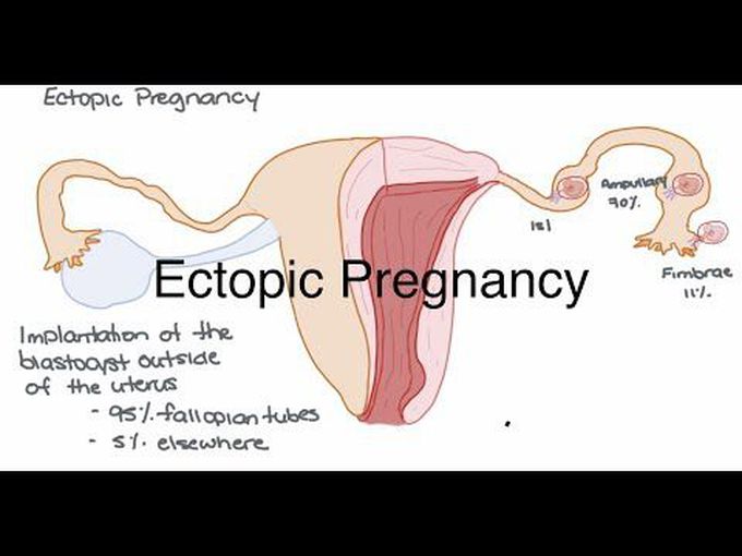 Extrauterine Implantation