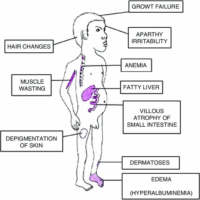 Signs of Kwashiorkor