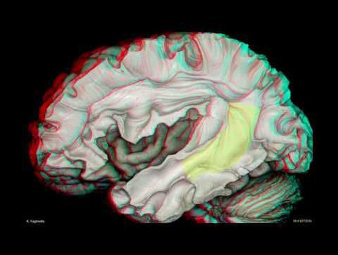 Fiber Pathways of the Cerebrum (3D Anaglyph)