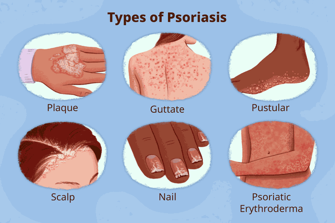 Types of Psoriasis