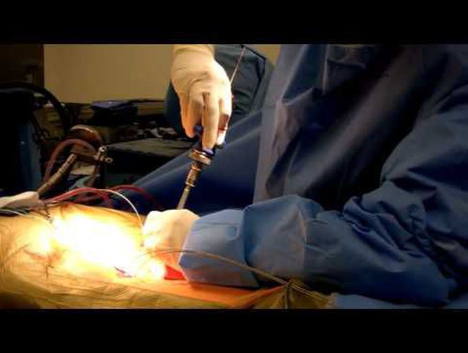Minimally invasive tubular surgery for transforaminal lumbar interbody fusion