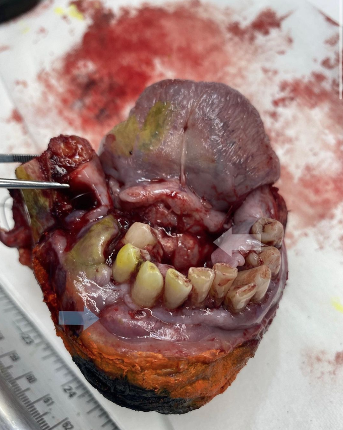 Radical Mandibulectomy with Glossectomy for Floor of Mouth Cancer!!