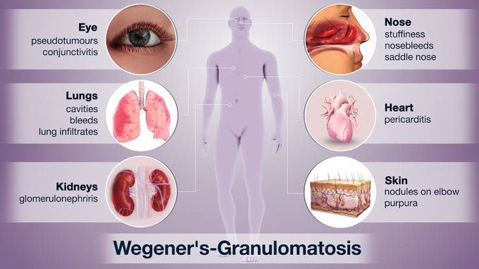 Wegners granulomatosis
