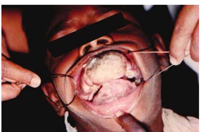 Fibromatosis