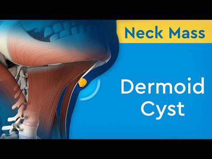 Dermoid cyst pathology.
