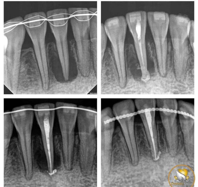 Healing process of Endo Procedure