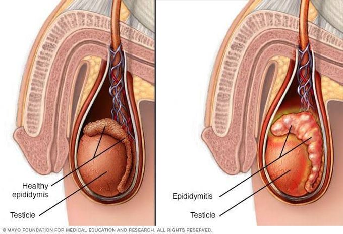 Causes of epididymitis