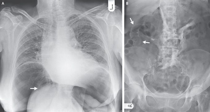 Rotation of the Liver in Pneumoperitoneum