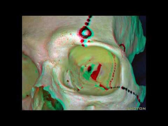 Obitozygomatic Approaches (3D Anaglyph)