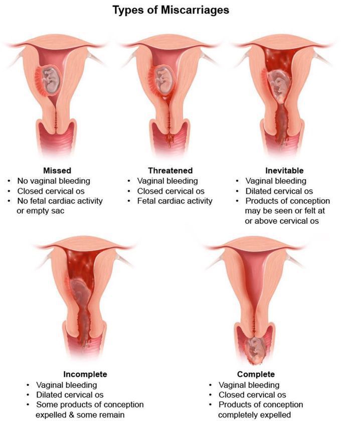 Types of Miscarriage