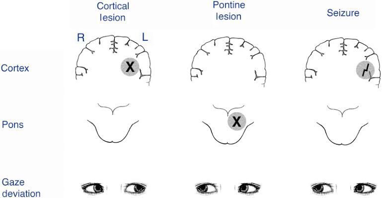 Gaze deviation in Neurological lesion - MEDizzy