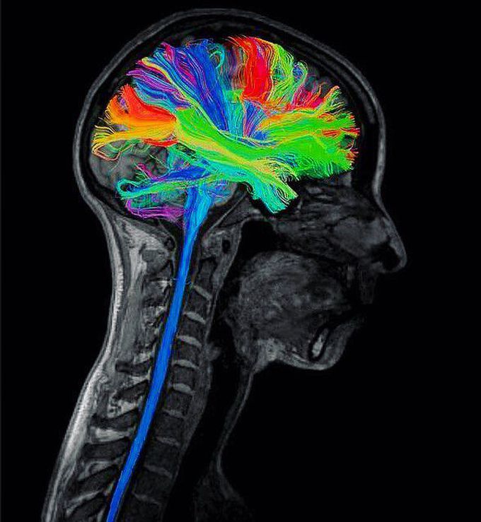 diffusion-tensor-imaging-dti-revealing-connectivity-in-the-brain