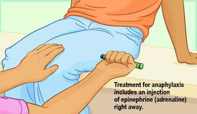 Treatment for Anaphylaxis