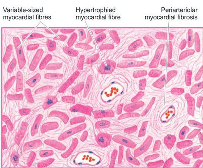 Chronic ischaemic heart disease