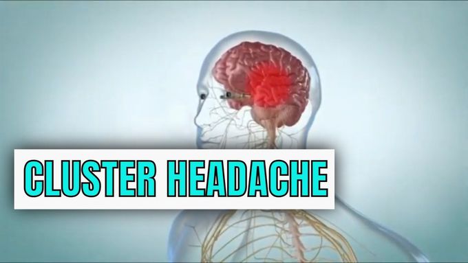 Cluster Headache ("Suicide" headache) Explained