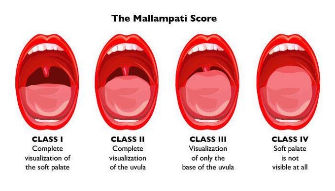 The Mallampati Score