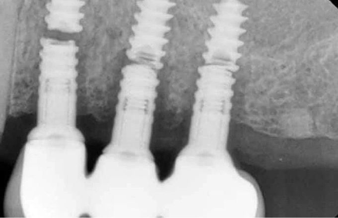 Implant Fracture