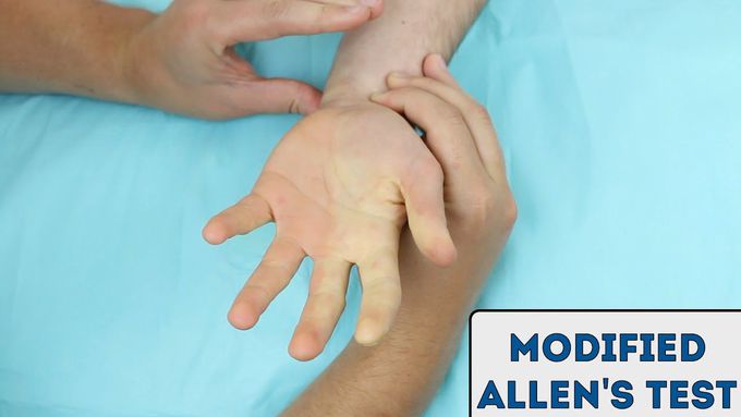 Modified Allen's Test